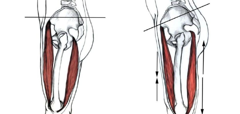 Pelvic tilt diagram showing muscle shortening